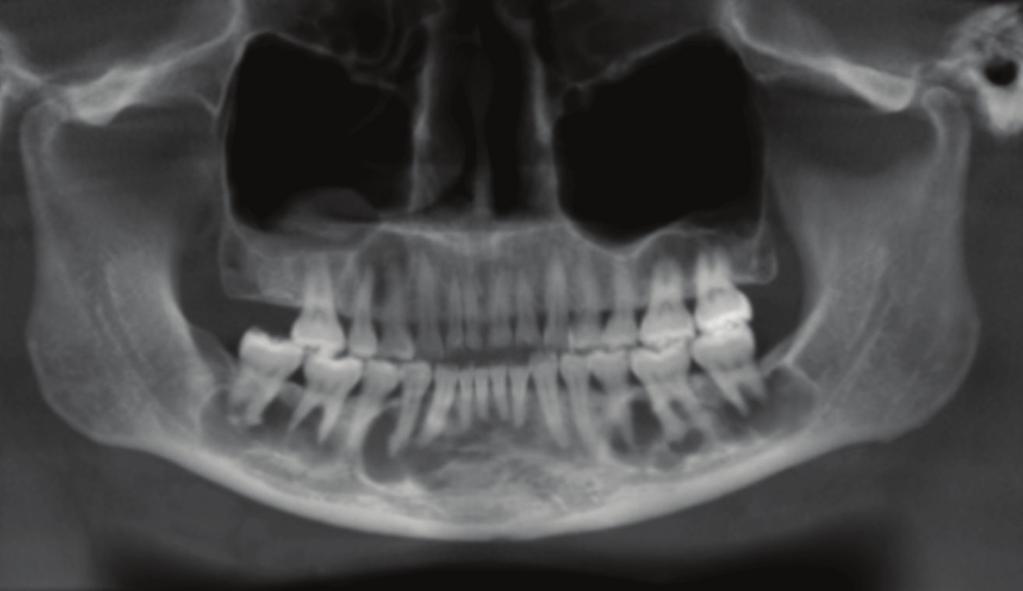 An oral and maxillofacial radiologist (VA), using the proprietary i-cat viewer software version 3.034, reviewed the images.