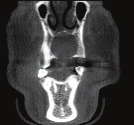 Relatively fewer common findings included sclerosing osteitis (17 subjects), oroantral fistula (14 subjects), hypercementosis (13 subjects), cemento-osseous dysplasia (Figure 3) (10 subjects),