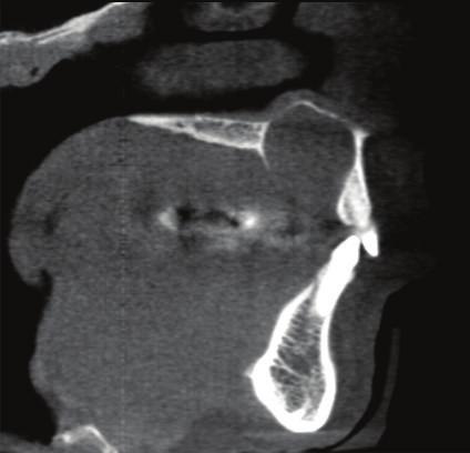 cementoblastoma, (4 subjects), nasopalatine canal cyst (3 subjects) (Figure 5), reactive hyperplastic osteitis (2 subjects), keratocystic odontogenic tumor (2 subjects), osteomyelitis (2 subjects),