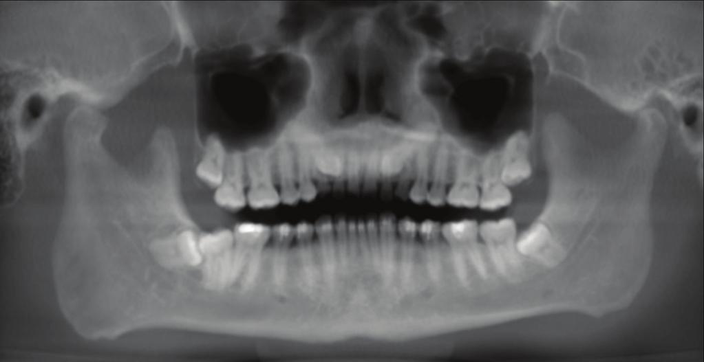 8 International Dentistry Figure 8: Hemihyperplasia seen as a much larger right side of the mandible on this panoramic reconstruction CBCT image.