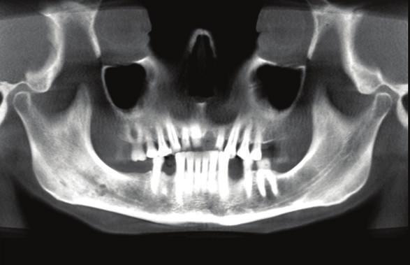 International Dentistry 9 Figure 10: A metastatic lesion seen as multiple poorly defined radiolucent areas (arrows) in the right side of the mandible causing loss of the cortical borders of the right