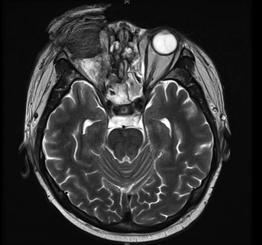 Post operative MRI T2 Image showing