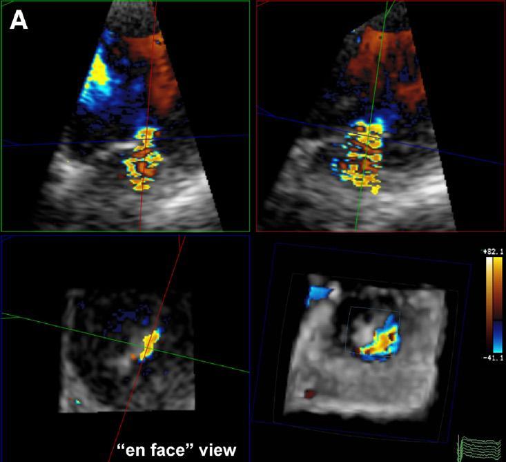 Quantification of Functional MR by RT3D Echocardiography