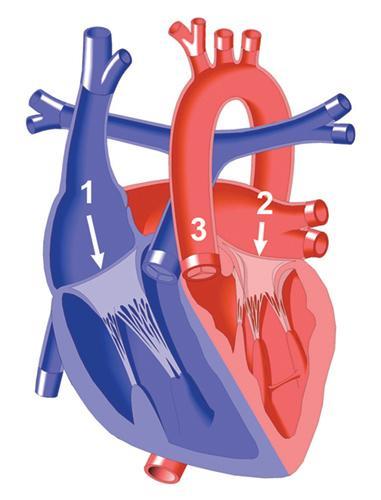Congenitally Corrected Transposition of the Great Arteries (cctga) Illustrations reprinted from PedHeart Resource. www.heartpassport.com. Scientific Software Solutions, 2010. All rights reserved C.