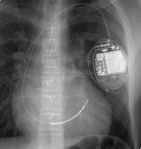 Implantation of Cardioverter Defibrillator After Percutaneous Closure of Atrial Septal Defect Figure 4. Location of the implantable cardioverter defibrillator lead. Figure 5.