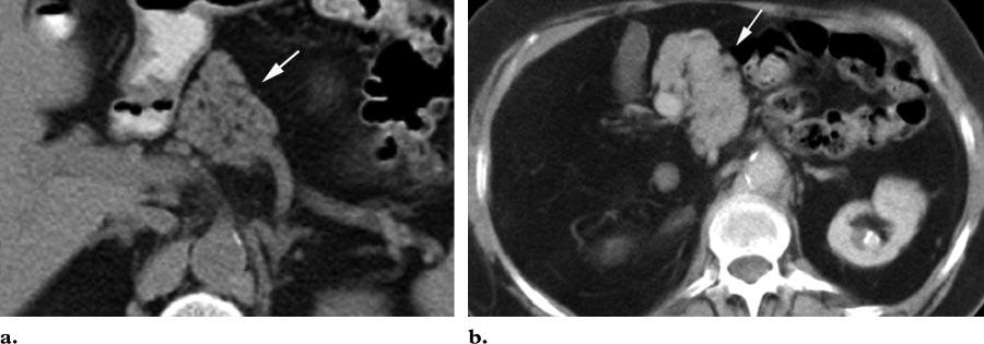 RG f Volume 26 Number 3 Mortelé et al 725 Figure 14. Pancreatic hypoplasia. (a) CT scan shows the pancreatic head (arrow) and absence of the pancreatic neck, body, and tail.