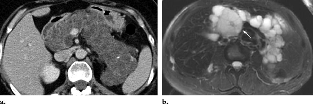 (a) Contrast material enhanced CT scan shows enhancing septa separating congenital pancreatic cysts.