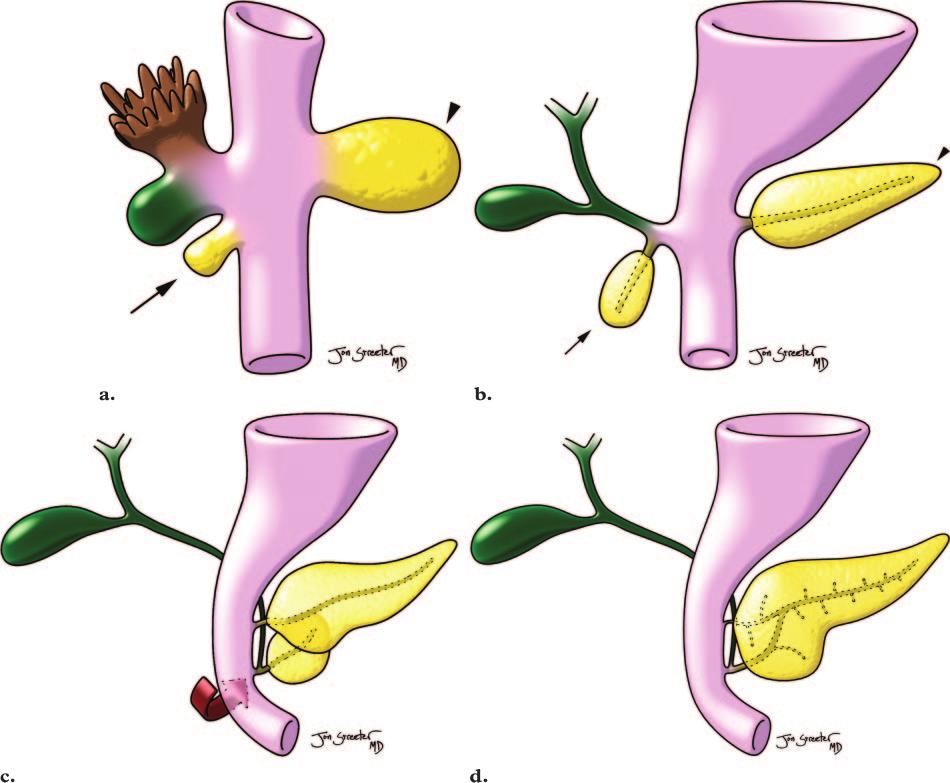 716 May-June 2006 RG f Volume 26 Number 3 Figure 1. Drawings illustrate the normal embryologic development of the pancreas and biliary tree.
