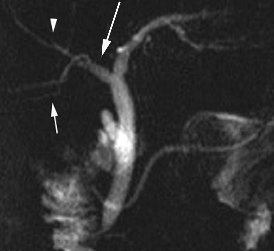 the right anterior duct (RAD), which drains the anterior segments (V and VIII). The RPD has an almost horizontal course, whereas the RAD tends to have a more vertical orientation.