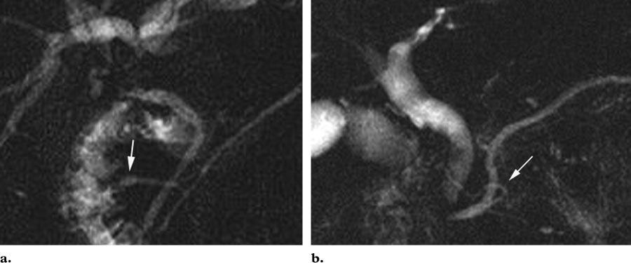 720 May-June 2006 RG f Volume 26 Number 3 Figure 6. Variant pancreatic ductal anatomy.