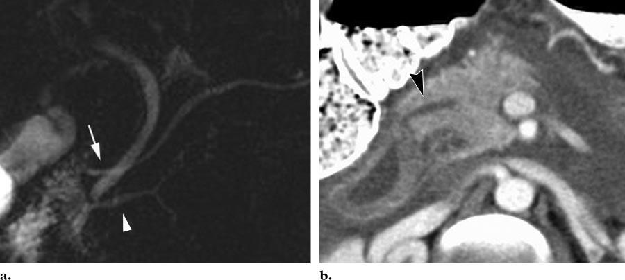RG f Volume 26 Number 3 Mortelé et al 723 Figure 11. Pancreas divisum. (a) Coronal MR cholangiopancreatogram shows drainage of the pancreas through the duct of Santorini (arrow).