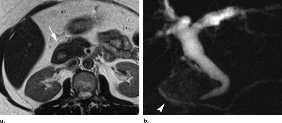 (b) CT scan obtained in a patient with acute recurrent pancreatitis and pancreas divisum shows a dilated duct of Santorini (arrowhead). Figure 12. Annular pancreas.