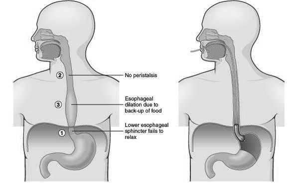 Pathologic Conditions Upper Gastrointestinal Tract Achalasia failure of the lower esophagus
