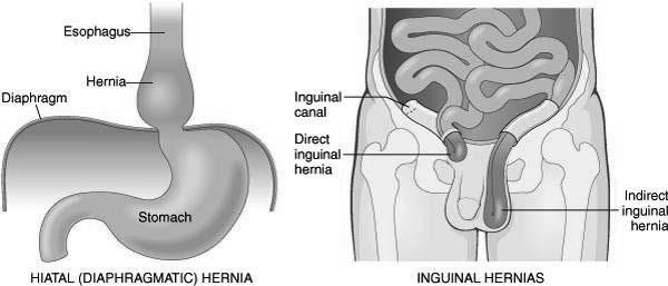 Pathologic Conditions Upper Gastrointestinal Tract (cont d) Hernia protrusion of an organ or part