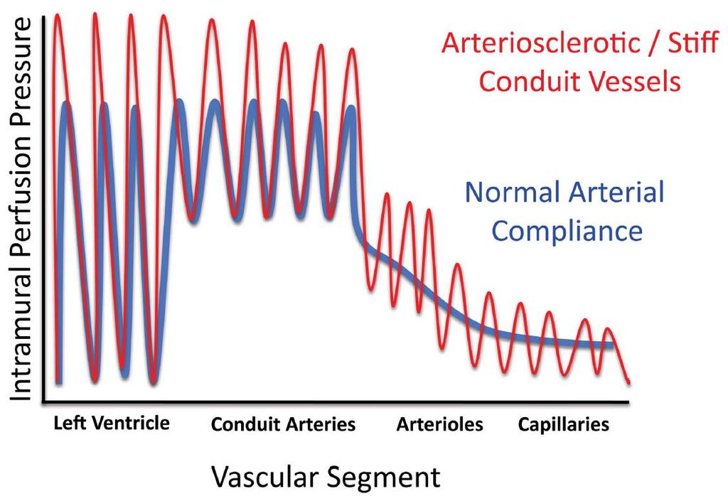Consequences of arterial stiffening and impaired Windkessel physiology During systole, some kinetic energy is stored as potential energy in the elastic conduit arteries for the coronary perfusion and