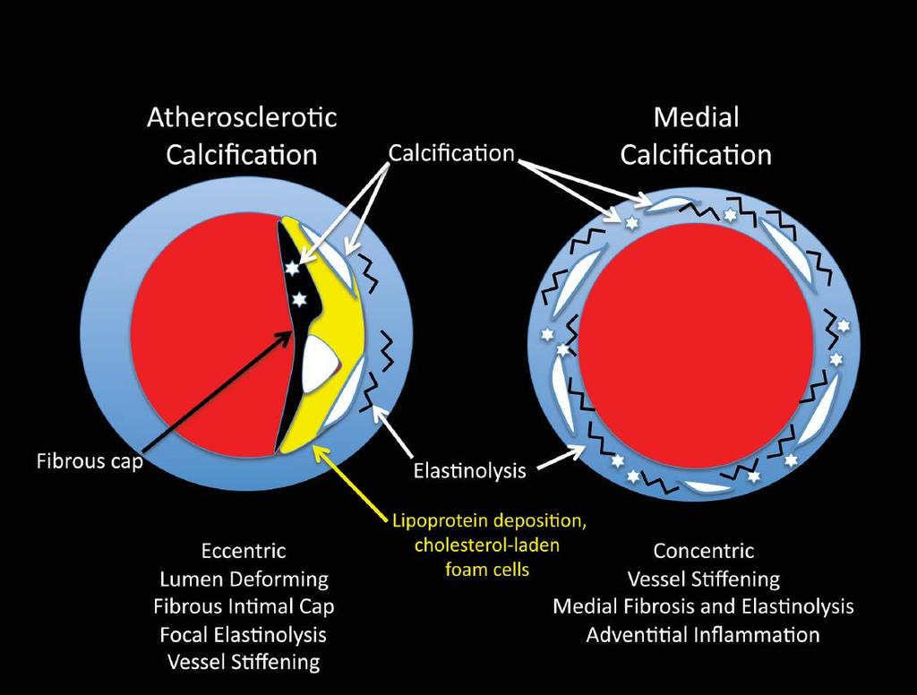 Atherosclerotic vs.