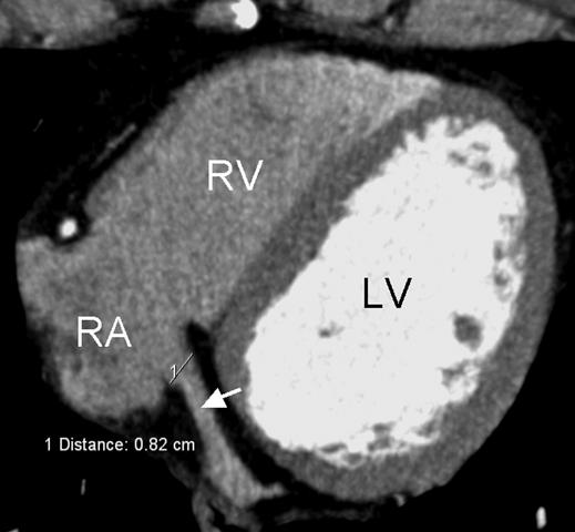 Imaging the Cardiac Venous System levels higher than 1.