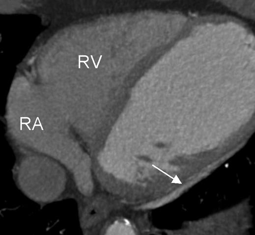 A, Example (multiplanar reformation) of measurement of vessel diameter at orifice of coronary sinus (arrow).