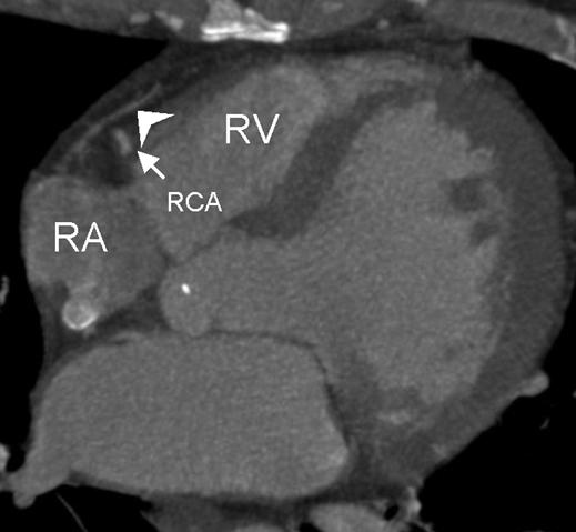 denotes RCA. Coronary Sinus Angiography Retrograde coronary catheter venography was performed via femoral venous access by an experienced cardiologist.