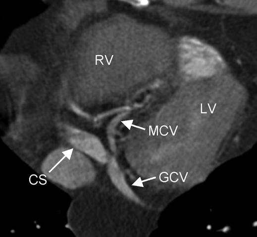 Imaging the Cardiac Venous System In selective retrograde conventional angiography, vessel evaluation was sometimes hindered by insufficient contrast of the cardiac veins.