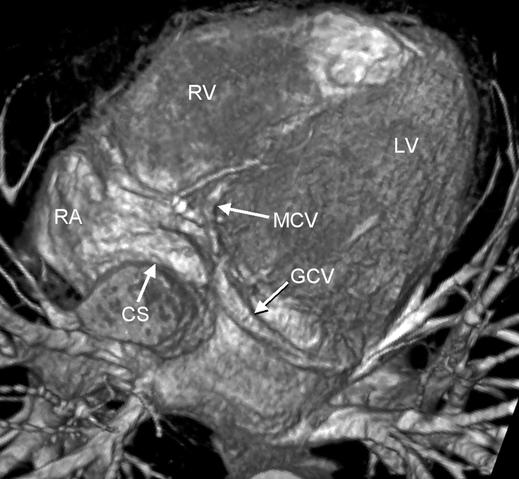 3 continues on next page) is delivered into the middle cardiac vein in retrograde perfusion angiography with selective intubation of the coronary sinus.