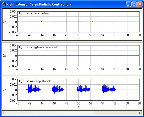 The screenshot below shows the recordings from all three EMG sensors during contractions performed by the right extensor carpi radialis longus.