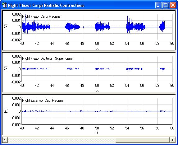 Data Analysis The screenshot below shows the recordings from all three EMG sensors during contractions performed by the right flexor carpi radialis.