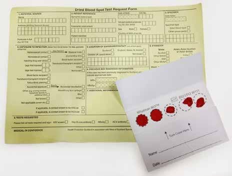 Dried Blood Spot (DBS) testing Dry blood spot testing Hepatitis C antibody testing Hepatitis C RNA detection OR Antigen detection HIV