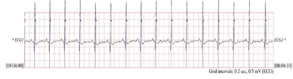Supraventricular Arrhythmia 800 signal of MIT- BIH In normal sinus rhythm of heart p-waves are pursued after a short gap.