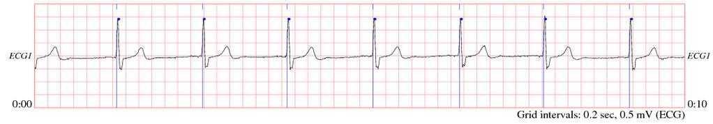 In Supraventricular Arrhythmia electrical signals or the electrical potential move through the upper chambers to lower chambers of the heart.