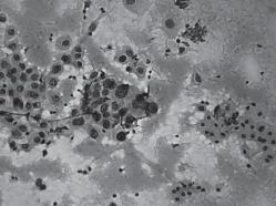 128 Ahuja A et al Fig. 2 : Microphotograph showing a cluster of malignant cells admixed with clusters of benign hepatocytes in a case of metastatic adenocarcinoma liver (H&E, x 256).
