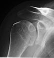 Limited ER key finding Adhesive capsulitis is a clinical diagnosis No need for MRI X-rays helpful to r/o glenohumeral joint arthritis X-rays courtesy of Dr.