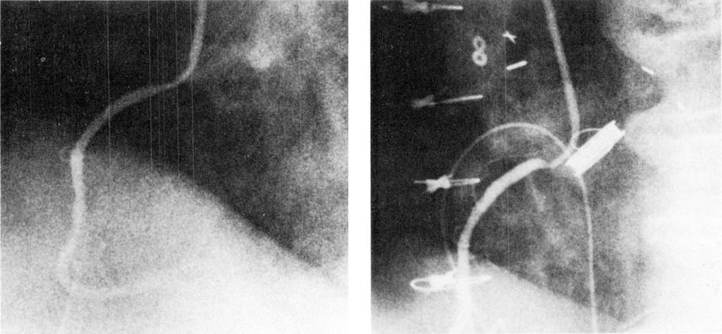 580 The Annals of Thoracic Surgery Vol 33 No 6 June 1982 A B Fig 2. (Patient 2.