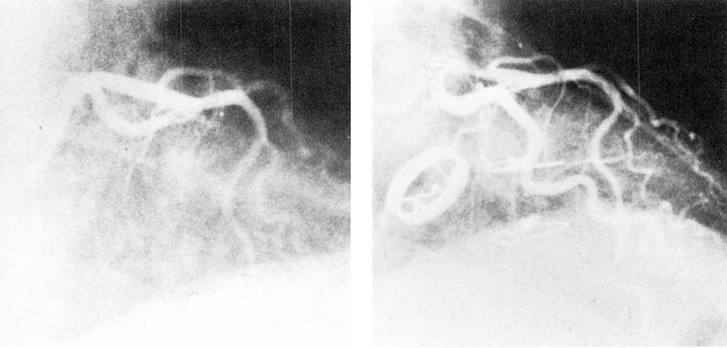 There is severe stenosis of the previously normal proximal left anterior descending coronary artery. A Fig 3. (Patient 1.