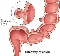 These are known as diverticula if there is more than one, or diverticulum, if there is only one (see figure 1).