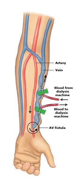 Vascular access An access creates a way for blood to be removed from the body, circulated through the dialysis machine, and then returned to the body at a rate that is higher than can be achieved