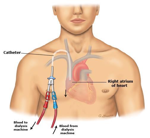Central venous catheter A central venous catheter uses a thin, flexible tube that is placed into a large vein (usually in the neck, under the skin).