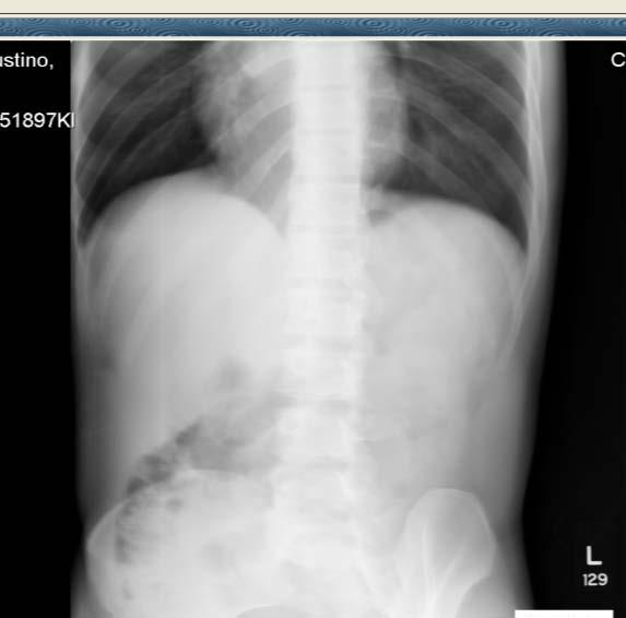Case Presentation VS: 146/93, 86, 18, 98% PE: suffering from pain Abdomen not distended Soft
