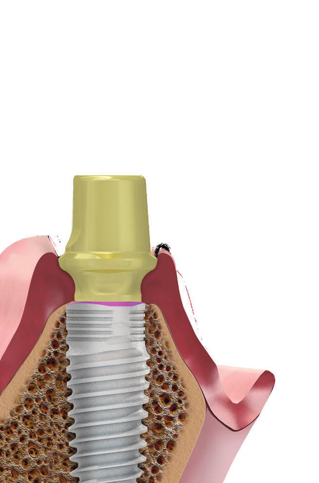 25 CONCAVE PROFILE Exclusive to conical connection abutments.
