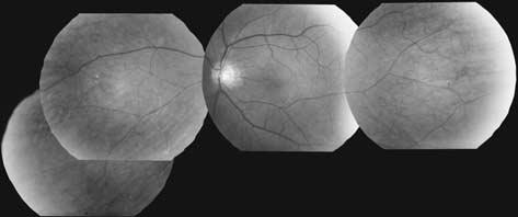 Clinical findings in carriers Heterozygous female carriers are mostly asymptomatic with no serious visual impairment and normal visual fields.