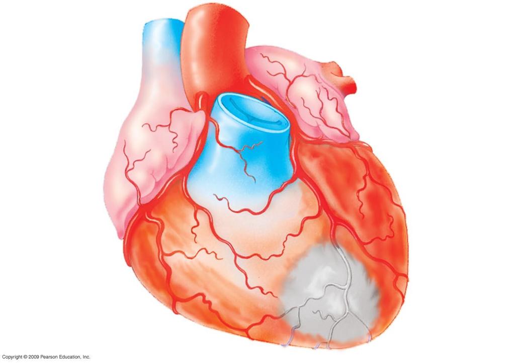 CONNECTION: What is a heart attack A heart attack is damage to cardiac muscle typically from a blocked coronary artery Stroke Death of brain tissue from blocked arteries in the