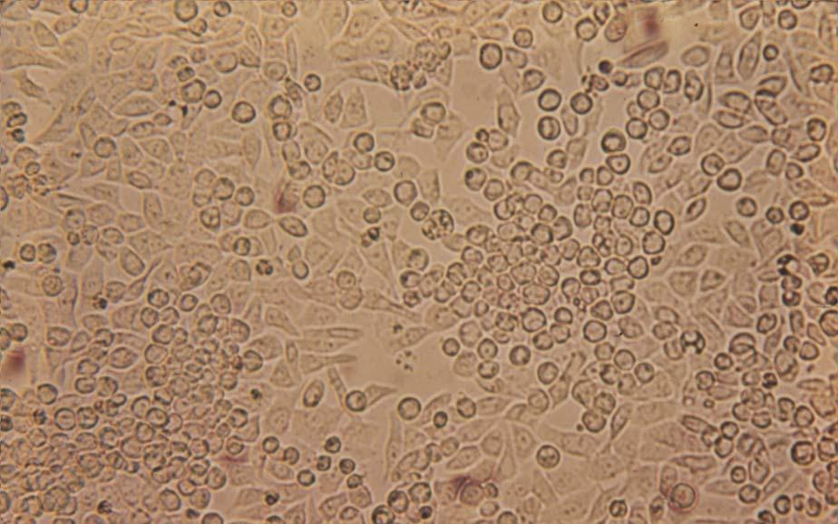 21 HEp-2 cells infected with herpes simplex virus (early CPE), 125X