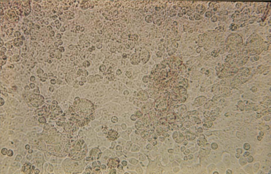 33 HEp-2 cells infected with rubeola virus (early CPE), 125X