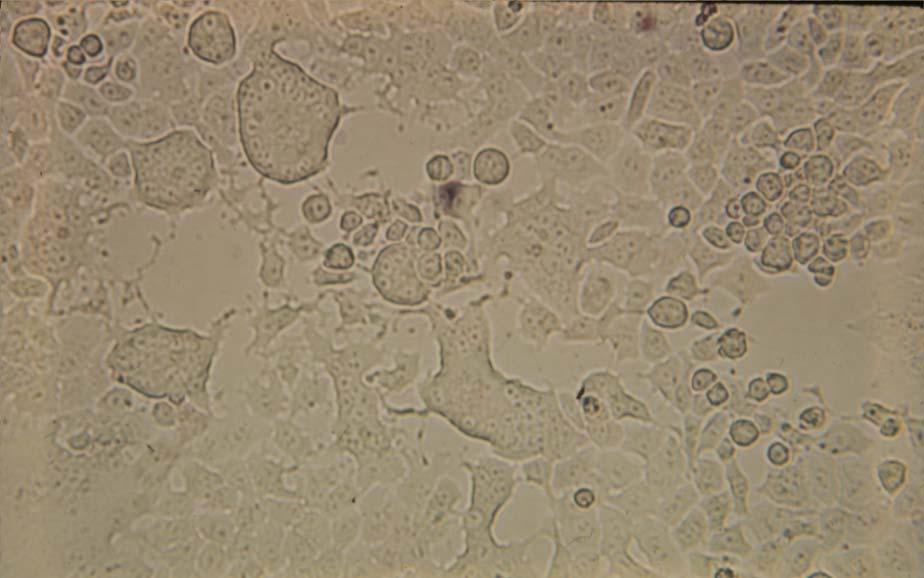 34 HEp-2 cells infected with rubeola virus (late CPE), 125X
