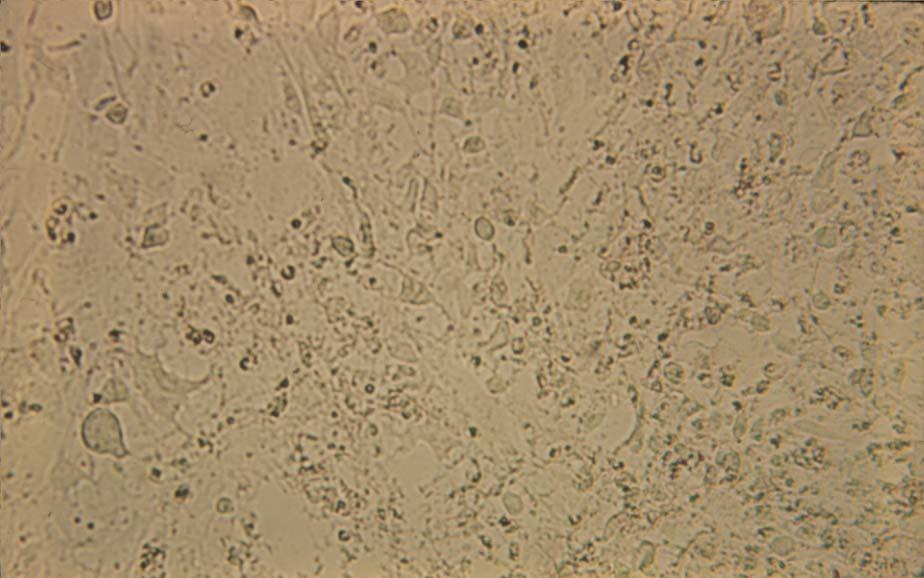 Diploid cells infected with varicella virus (late CPE), 125X Almost all of the cells are involved