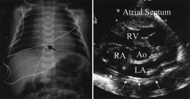 Echocardiographic Evaluation of Umbilical Venous Catheter Placement Ades et al.