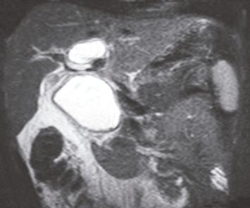 well-circumscribed fusiform tracer accumulation in the right hepatic lobe near the hepatic hilum is clearly visible from the 15 th min of the study (arrow), and corresponds to a dilated intrahepatic