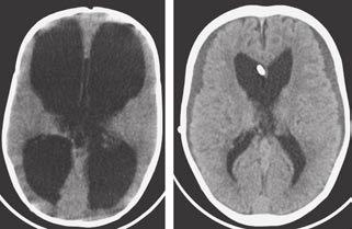 A Female Patients Brain Volume (cm 3 ) 12 1 8 6 4 2 Both Groups Ventriculoperitoneal-Shunt Group Group 12 1 C 12