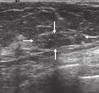 Management of LCIS Diagnosed at Core Needle Biopsy A of histopathologically confirmed cases of LCIS at needle core biopsy, given that 54 of the 64 lesions were visualized mammographically (Figs.
