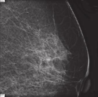 A D, Mammographic views (A and B) and magnified views (C and D) show area of diffuse amorphous and pleomorphic calcifications